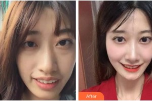 寶雞市口腔醫(yī)院馮光偉整形價(jià)格表附牙齒陶瓷矯正案例展示