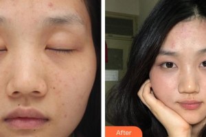 常熟時(shí)代醫(yī)療美容醫(yī)院周庭立整形價(jià)格表附激光祛斑案例展示