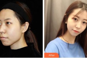 常熟金山整形美容門診部萬衛(wèi)東整形價(jià)格表附光子嫩膚案例展示