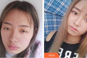 常熟市第二人民醫(yī)院眼科邢茜整形價(jià)格表附切開雙眼皮案例展示