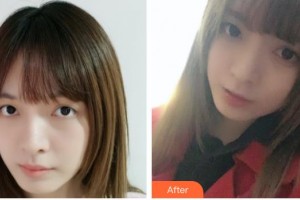 常熟市第二人民醫(yī)院眼科周衛(wèi)文整形價(jià)格表附切開雙眼皮案例展示