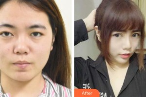 常熟市第二人民醫(yī)院眼科陶建軍整形價(jià)格表附眼部綜合案例展示