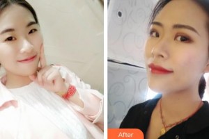 常熟廣仁醫(yī)院眼科薛振芳整形價(jià)格表附埋線雙眼皮案例展示