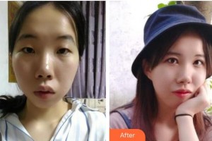 常熟市第二人民醫(yī)院眼科黃正如整形價(jià)格表附切開雙眼皮案例展示