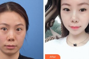 貴州整形美容外科醫(yī)院梁安裕整形價(jià)格表附激光祛斑案例展示