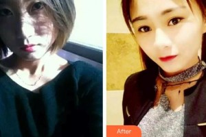 貴州整形美容外科醫(yī)院劉磊整形價(jià)格表附激光祛斑案例展示