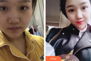 貴州省紅十字會(huì)婦女兒童醫(yī)院整形美容中心謝詩(shī)思整形價(jià)格表附紅藍(lán)光祛痘案例展示