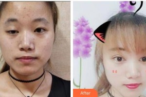 貴州醫(yī)科大學(xué)第二附屬醫(yī)院醫(yī)學(xué)美容整形外科彭洲整形價(jià)格表附彩光嫩膚案例展示