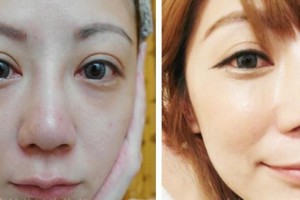 貴州省人民醫(yī)院整形美容燒傷顯微外科程代薇整形價(jià)格表附光子嫩膚案例展示