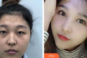 貴州醫(yī)科大學(xué)第二附屬醫(yī)院醫(yī)學(xué)美容整形外科楊光朝整形價(jià)格表附眼部綜合案例展示