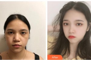 貴州歐貝頤醫(yī)療整形醫(yī)院孫超整形價(jià)格表附去痘印痘坑案例展示