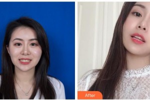 貴州晶朗眼科醫(yī)院趙國(guó)義整形價(jià)格表附金屬托槽矯正案例展示