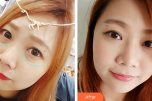 貴州晶朗眼科醫(yī)院?jiǎn)剔闭蝺r(jià)格表附眶隔脂肪釋放案例展示