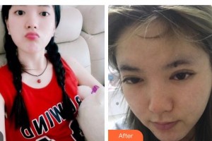 貴州晶朗眼科醫(yī)院劉媛整形價(jià)格表附眼部綜合案例展示