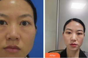 貴州晶朗眼科醫(yī)院董高亮整形價(jià)格表附激光去眼袋案例展示