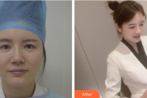 貴州晶朗眼科醫(yī)院王明武整形價格表附上眼瞼去脂案例展示