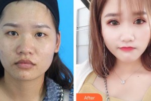 貴州晶朗眼科醫(yī)院陳曦整形價格表附切開雙眼皮案例展示