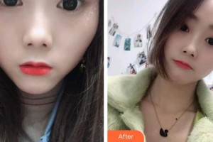 貴陽愛爾眼科醫(yī)院陳曉鐘整形價格表附切開雙眼皮案例展示