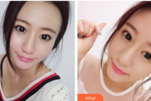 貴陽(yáng)愛(ài)爾眼科醫(yī)院劉誠(chéng)整形價(jià)格表附眼部修復(fù)案例展示