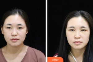 貴陽(yáng)愛(ài)爾眼科醫(yī)院劉忠華整形價(jià)格表附眼部綜合案例展示