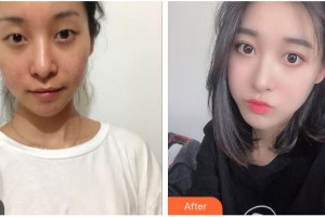 貴陽愛爾眼科醫(yī)院廖進軍整形價格表附切開雙眼皮案例展示