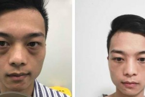 貴陽愛爾眼科醫(yī)院黃加兵整形價格表附激光去眼袋案例展示