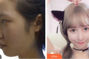 貴陽(yáng)愛(ài)爾眼科醫(yī)院陳筑惠整形價(jià)格表附切開(kāi)雙眼皮案例展示