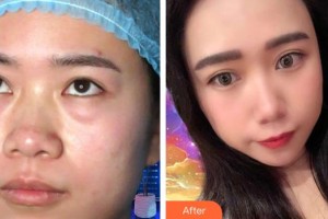 貴陽愛爾眼科醫(yī)院王文放整形價格表附內(nèi)切祛眼袋案例展示