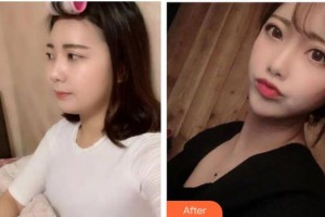 貴陽愛爾眼科醫(yī)院楊潔整形價格表附切開雙眼皮案例展示