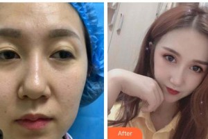 六盤水麗人醫(yī)院醫(yī)療美容科劉曉君整形價格表附眼部綜合案例展示