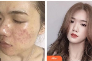 遵義利美康整形美容醫(yī)院章超整形價格表附紅藍(lán)光祛痘案例展示