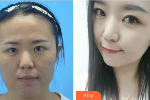 遵義利美康整形美容醫(yī)院吳琳紋繡中心主任整形價格表附激光祛斑案例展示