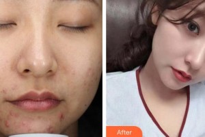 遵義利美康整形美容醫(yī)院王波整形價格表附激光祛斑案例展示