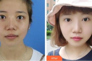 遵義利美康整形美容醫(yī)院龍文萍整形價格表附激光祛斑案例展示