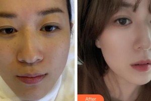 遵義利美康整形美容醫(yī)院羅曉珊高級紋繡師整形價格表附激光祛斑案例展示