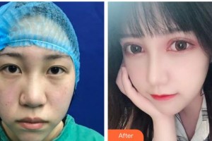 遵義韓美整形美容醫(yī)院彭楠整形價格表附切開雙眼皮案例展示