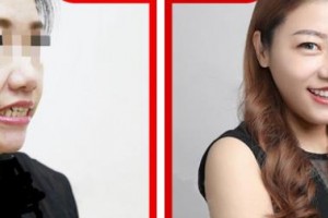 遵義醫(yī)學(xué)院附院美容醫(yī)院咼連勝整形價格表附牙齒隱形矯正案例展示