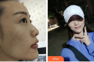 遵義紅美整形美容醫(yī)院仇軍整形價格表附激光祛斑案例展示