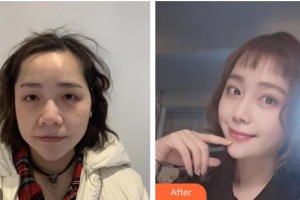 遵義紅美整形美容醫(yī)院曾斌整形價格表附埋線提升案例展示