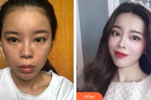 遵義韓美整形美容醫(yī)院柯茂華整形價格表附埋線提升案例展示