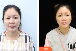 遵義利美康整形美容醫(yī)院唐芳明整形價格表附埋線提升案例展示