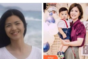 遵義利美康整形美容醫(yī)院陳學(xué)會整形價格表附牙齒隱形矯正案例展示