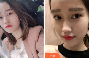 遵義利美康整形美容醫(yī)院朱豐整形價格表附牙齒隱形矯正案例展示