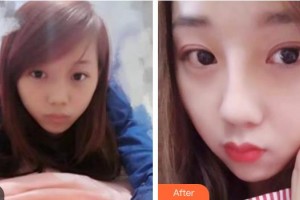 遵義喬雅菲醫(yī)療美容門(mén)診部彭于賓整形價(jià)格表附清潔祛痘案例展示