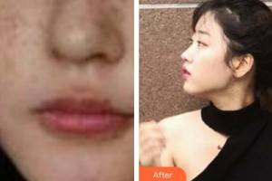 遵義韓美整形美容醫(yī)院李正鵬整形價(jià)格表附激光祛斑案例展示