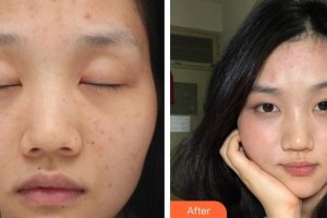 遵義韓美整形美容醫(yī)院于建濤整形價(jià)格表附激光祛斑案例展示