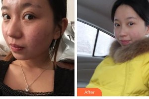 遵義韓美整形美容醫(yī)院楊艷艷整形價(jià)格表附光子嫩膚案例展示