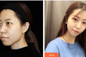 遵義韓美整形美容醫(yī)院吳靜整形價(jià)格表附光子嫩膚案例展示