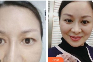 銅仁白領(lǐng)醫(yī)療美容門診部錢炳燊整形價格表附埋線雙眼皮案例展示