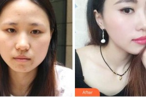 銅仁仁愛眼科醫(yī)院蔣海贇整形價格表附切開雙眼皮案例展示